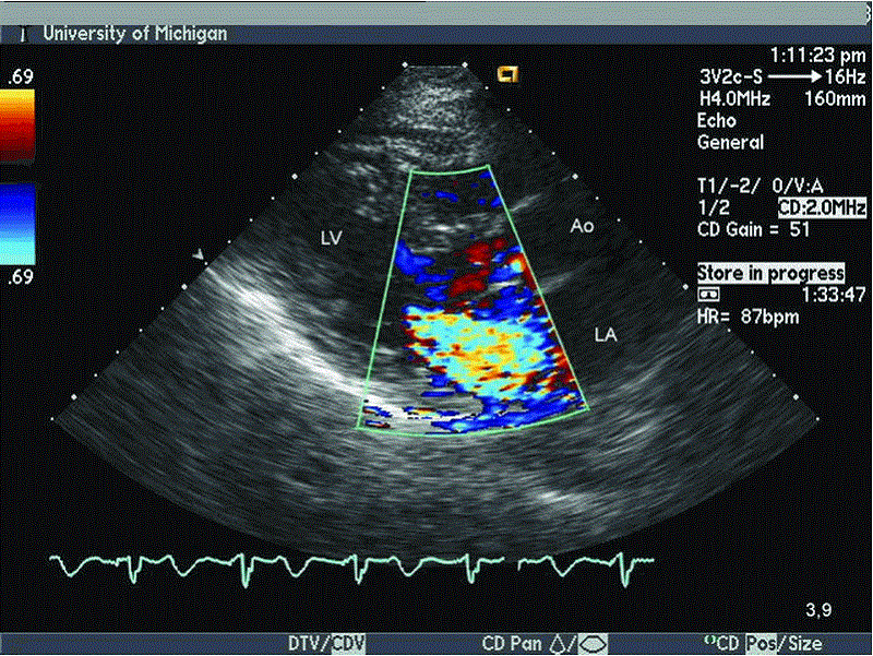 Siêu âm tim thấy hình ảnh hở van hai lá trên SA Doppler